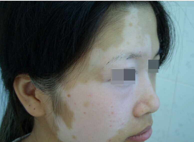 导致女性患上白癜风的成因是什么 导致女性患上白癜风的成因是什么