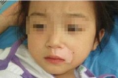 接触白癜风患者会被传染吗 接触白癜风患者会被传染吗