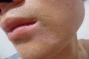 你中了几枪?盘点诱发白癜风的因素 你中了几枪?盘点诱发白癜风的因素
