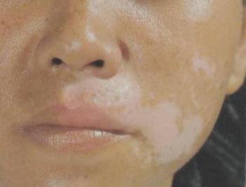 临沂平邑哪家白癜风医院比较好 临沂平邑哪家白癜风医院比较好