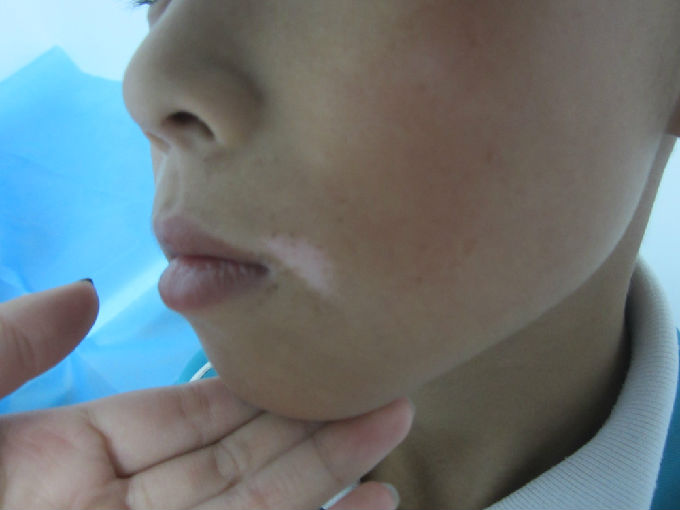 治疗白癜风的好方法有什么 治疗白癜风的好方法有什么