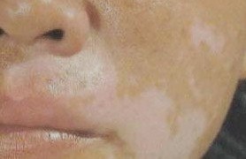 临沂临沭治疗白癜风到哪家医院效果好 临沂临沭治疗白癜风到哪家医院效果好